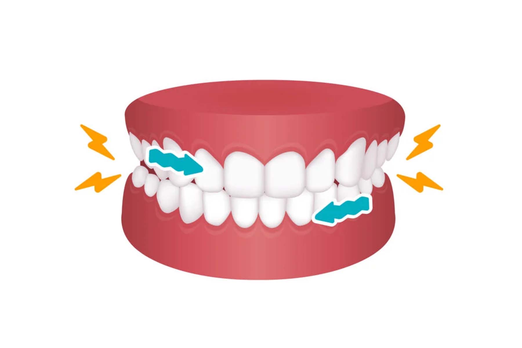 Tooth Grinding (Bruxism)